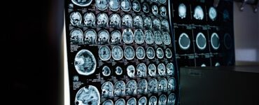 MRI Images of the Brain