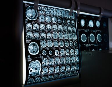 MRI Images of the Brain